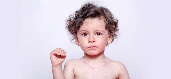 What to do if your child gets measles?